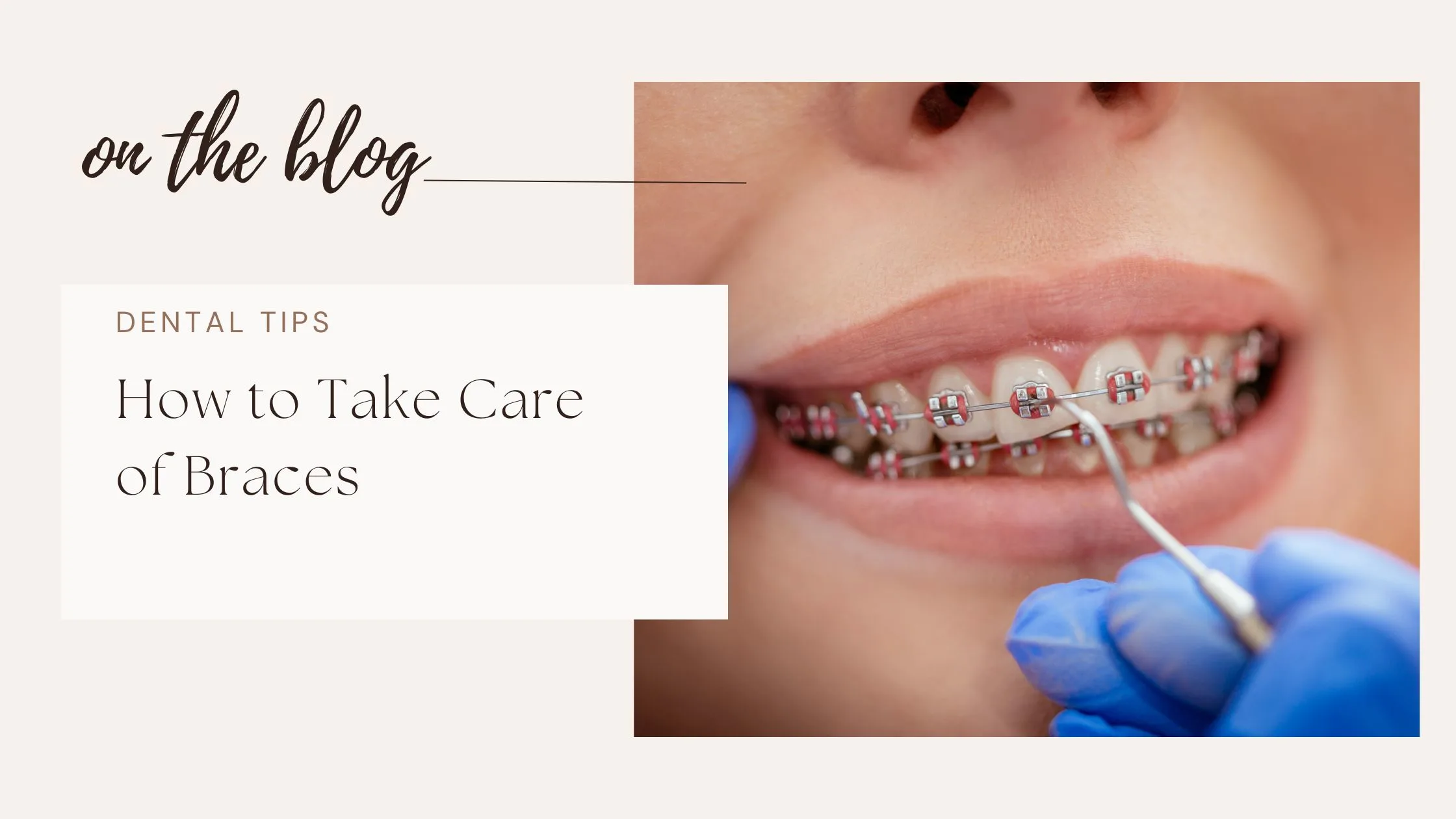 How to Take Care of Braces